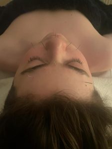 Facial acupuncture image